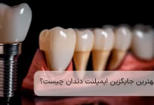 dental implants are the best choice for tooth replacement.jpg