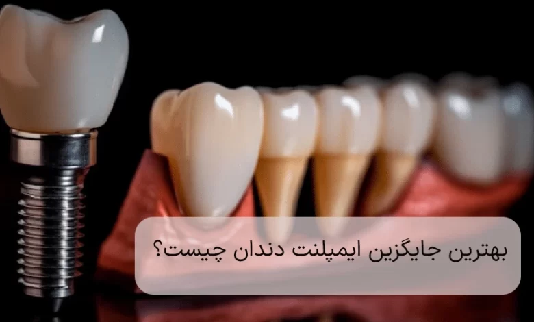 dental implants are the best choice for tooth replacement.jpg