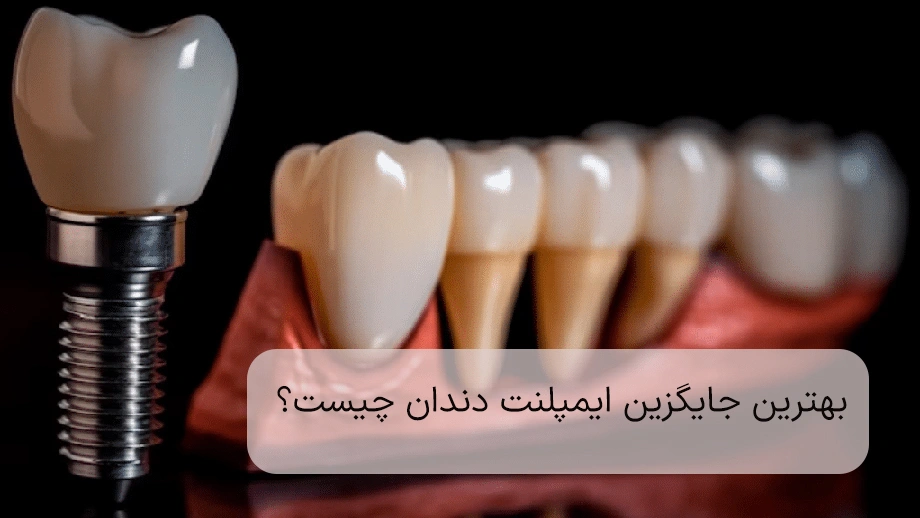 dental implants are the best choice for tooth replacement.jpg