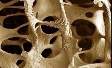 کمبود این ماده معدنی سبب پوکی استخوان می‌شود