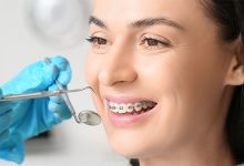 انواع روش های ارتودنسی
